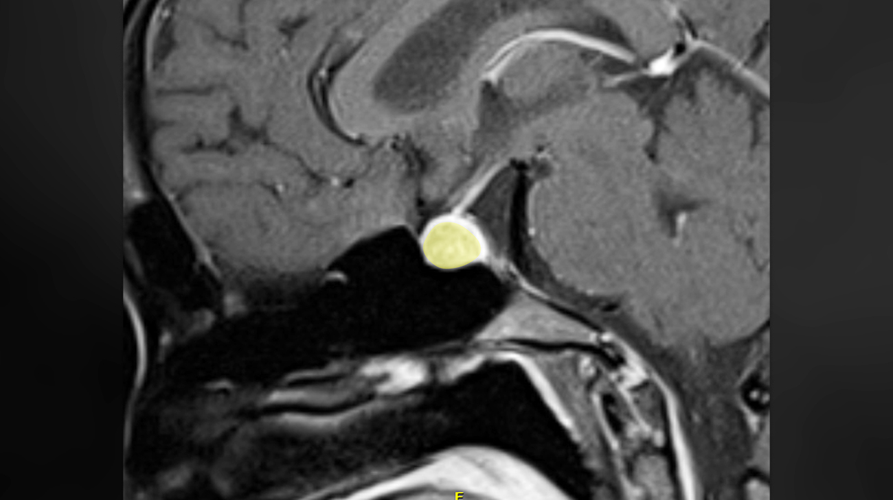 Tumor in the pituitary gland outlined in yellow, normal gland is thin rim of bright enhancement compressed and pushed by the tumor.