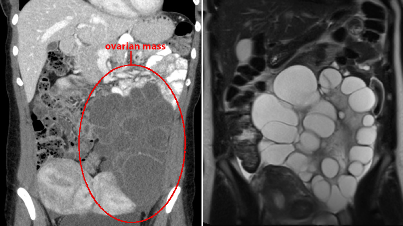Brittany’s ovarian mass measured 186 millimeters, or 18.6 centimeters, on a CT scan in January 2025. It grew to 22 cm, or 8.6 inches, about the diameter of a soccer ball, before surgery in October. 